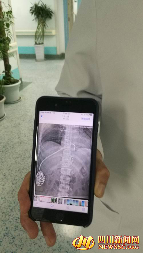 心脏起搏器治疗心律失常,40岁女性心跳一分钟54次