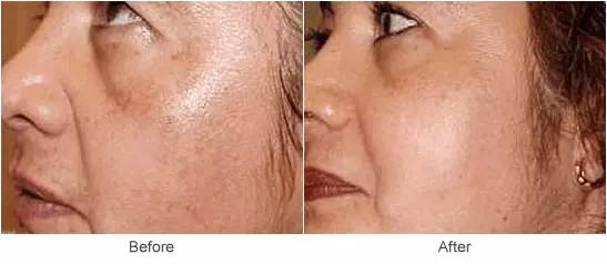 毛孔粗大怎么拯救,十滴水拯救粗大毛孔