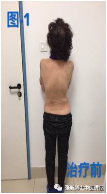 小针刀治疗脊柱侧弯,脊柱侧弯小针刀可以治愈吗