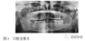 下颌下腺肿瘤是什么原因引起的,下颌下腺瘤有什么症状
