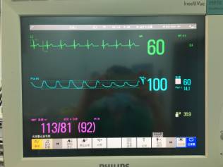 围手术期个案护理比赛优秀案例ppt,术后镇痛的规范化管理ppt