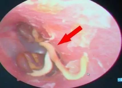 4岁男孩把黄豆塞进耳朵,小男孩把豆子塞耳朵里了