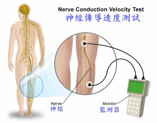 解决坐骨神经痛的穴位,坐骨神经最快治愈手法
