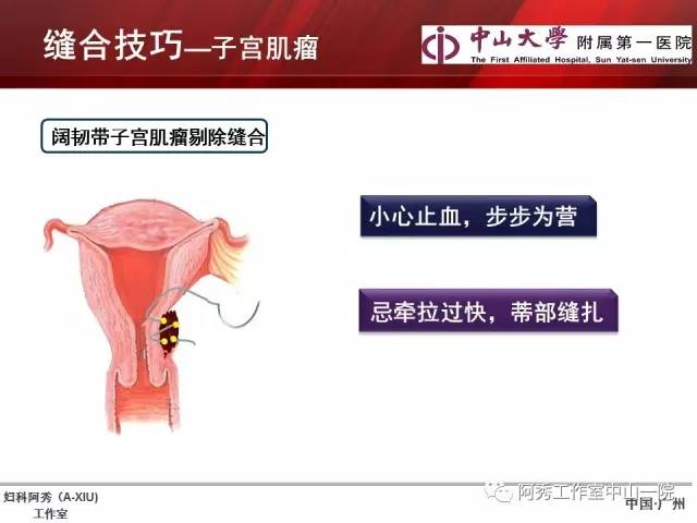 妇科腹腔镜下常用缝合技巧