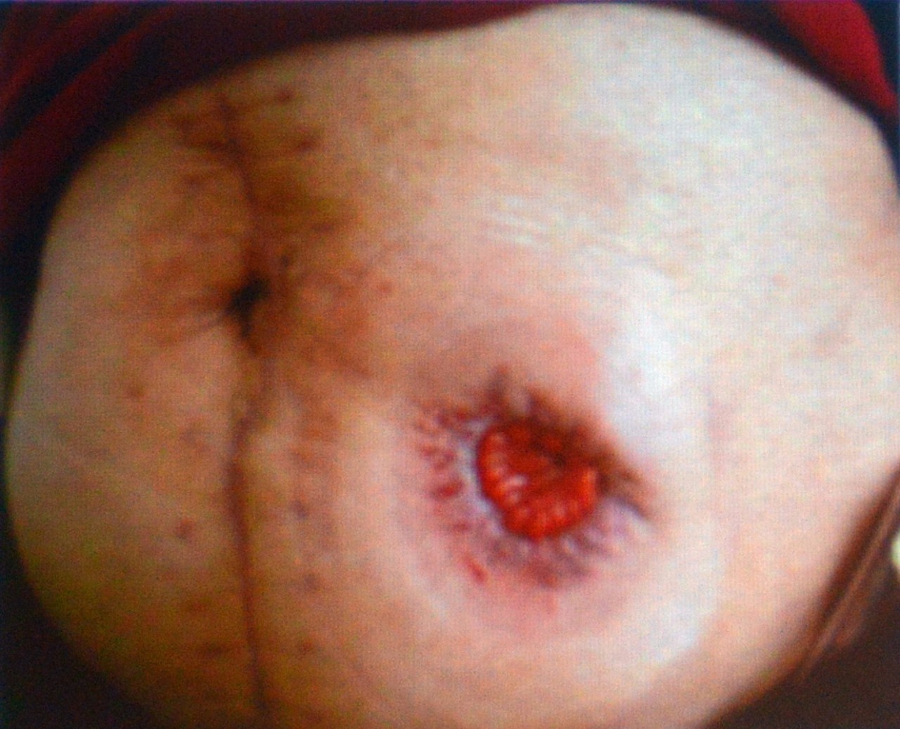 肠造口常见周围皮肤并发症,肠造口护理操作并发症