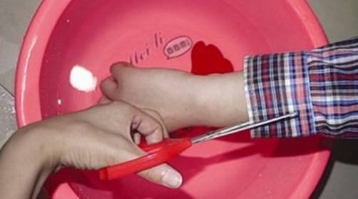 90度开水大面积烫伤急救,儿童开水烫伤急救处理