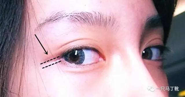 想让眼睛更有神,想让眼睛不肿做什么项目