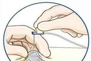 杈撴恫娓澏褰㈤拡绌垮埡瑙嗛,铦剁考閽堝埡鍏ヨ緭娑叉腐鎿嶄綔娴佺▼