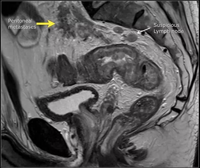 记住一个单词的一般方法,记住癌症九字诀