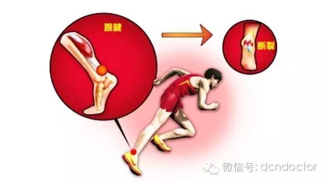 跟腱真的那么脆弱吗,跟腱为什么这么脆弱