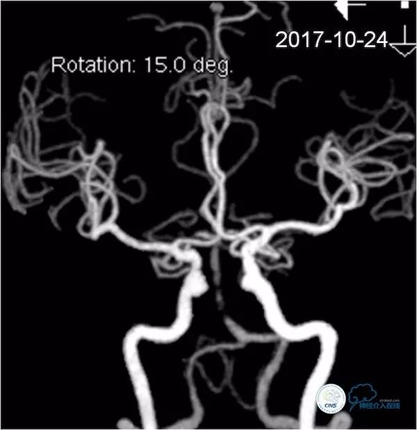 天坛医院脑血管狭窄手术做得好吗,天坛医院动脉狭窄介入手术费用