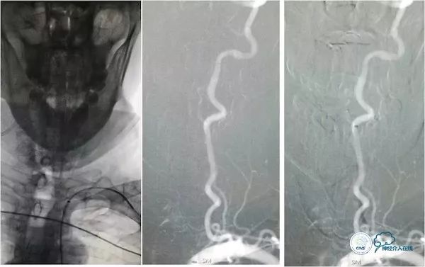 天坛医院脑血管狭窄手术做得好吗,天坛医院动脉狭窄介入手术费用