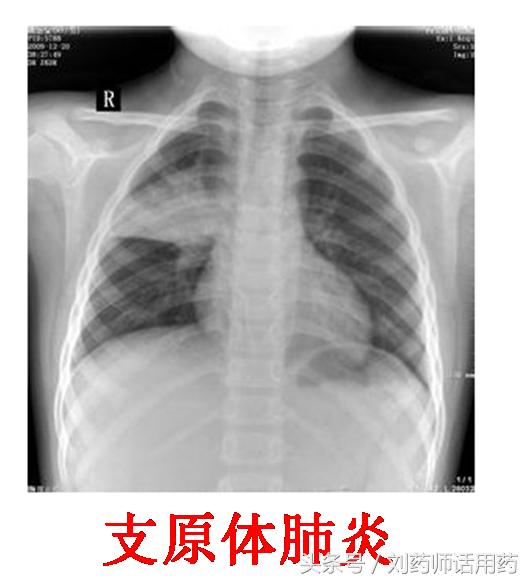 阿奇霉素治疗儿童支原体肺炎用量,阿奇霉素治疗支原体肺炎几天见效