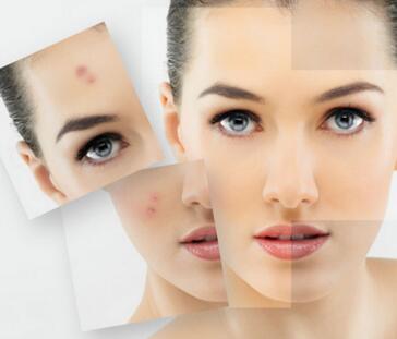 长痘痘可以做激光祛痘吗,激光祛痘有哪种仪器