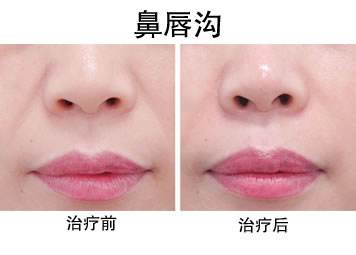 娱乐圈不老男神的秘诀,明星们的冻龄秘诀玻尿酸