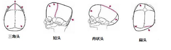 广州哪家医院可以矫正儿童头型,孩子头型问题