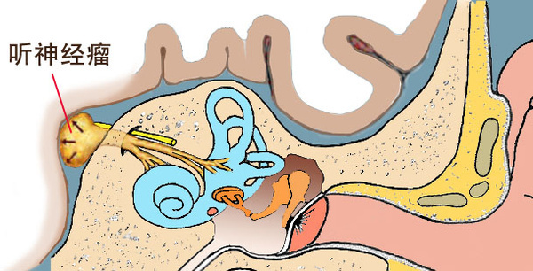 长期单侧耳鸣会是鼻咽癌吗,单侧耳鸣警惕四种疾病