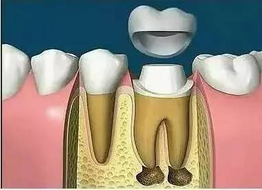 根管治疗加修复牙齿,根管治疗的牙齿都要打桩吗