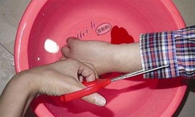 滚烫开水烫伤现场如何急救,手背被开水烫伤了怎么急救