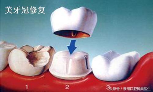 保留坏牙的几种方法,坏牙是不是越早拔越好