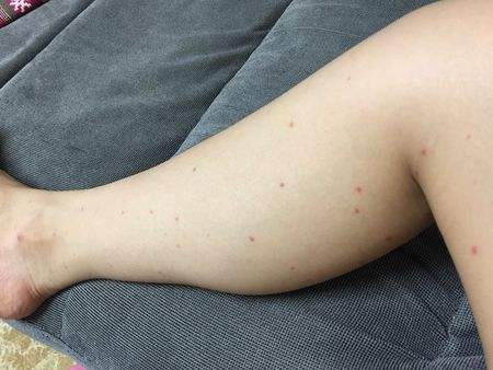 有像痣一样的小红点不痛不痒,身上长小红点像小白点