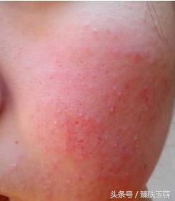 换季起皮红血丝,敏感皮肤有红血丝先去哪里