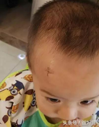 孩子摔跤到膝盖出血该怎么处理,四岁孩子摔跤缝了22针