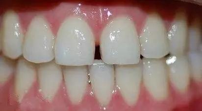 牙缝大会漏财吗,前面牙缝大漏财真的吗