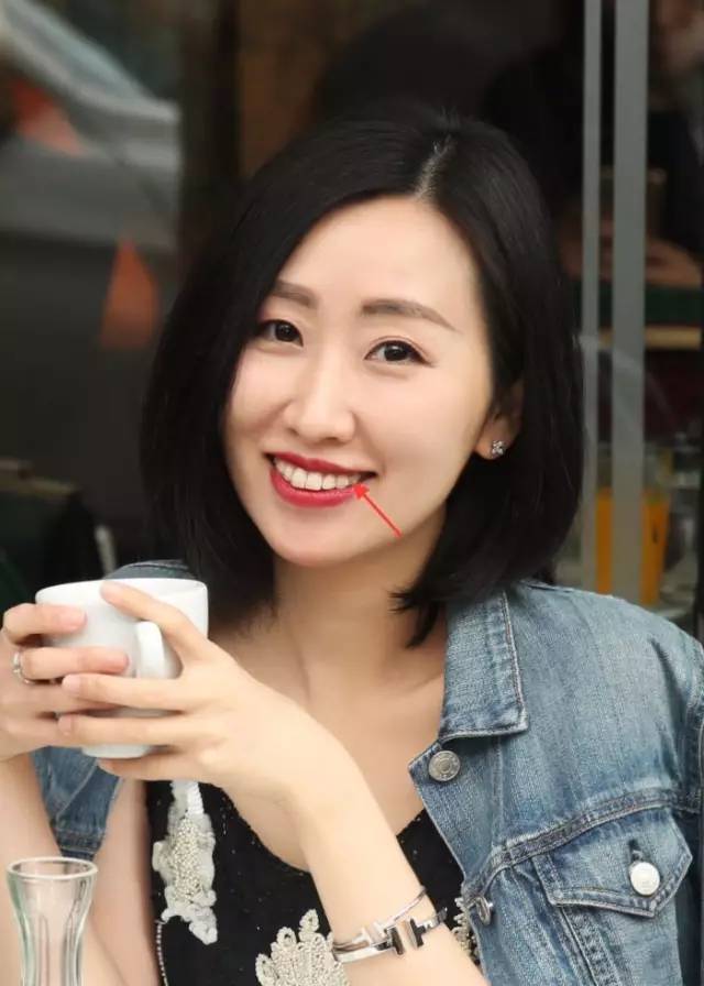 整牙戴的粉色的牙套,整牙给人带来的变化