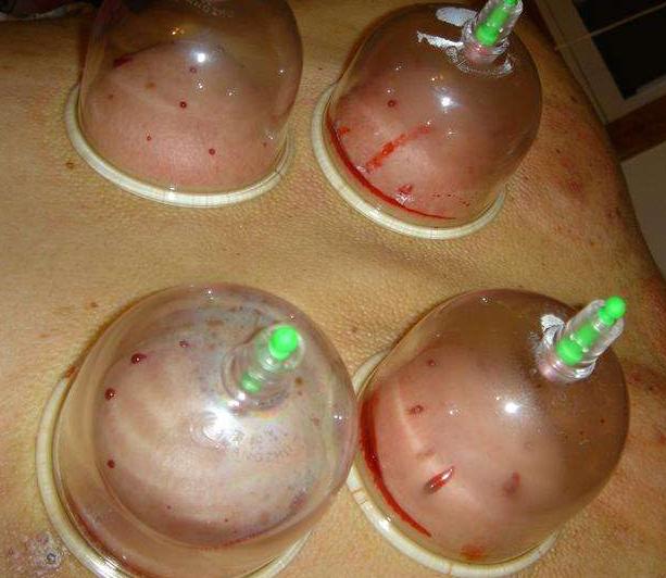 艾灸后很上火怎么办,上火艾灸什么部位降火