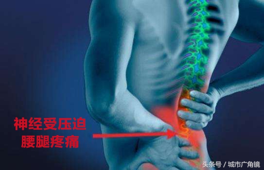 腰椎间盘突出脚底板麻木如何治疗,腰椎间盘突出腿麻木最快缓解针灸