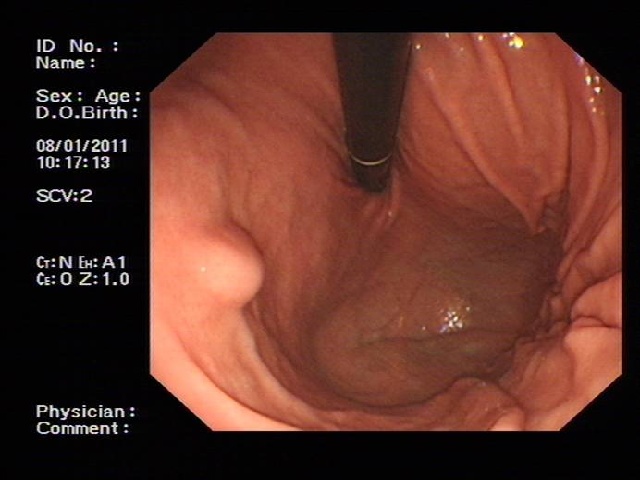 保护胃粘膜根除幽门螺旋杆菌 (怎么杀幽门螺旋杆菌治胃病)