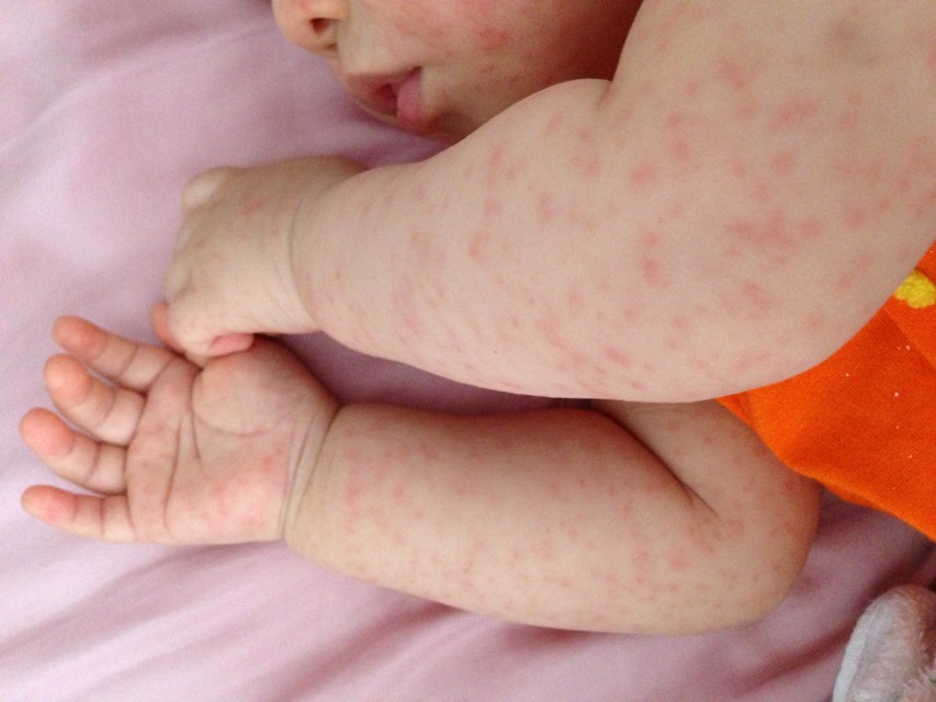 九个月宝宝出了一身疹子,9个月宝宝出些小红疹低烧