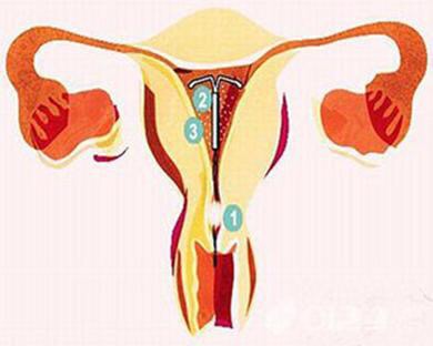 上环是对子宫的一种伤害吗,上环需要清宫吗