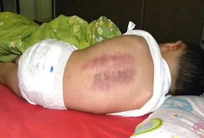 宝宝发烧预防脑损伤吃什么药预防,宝宝发烧引起脑炎怎么办