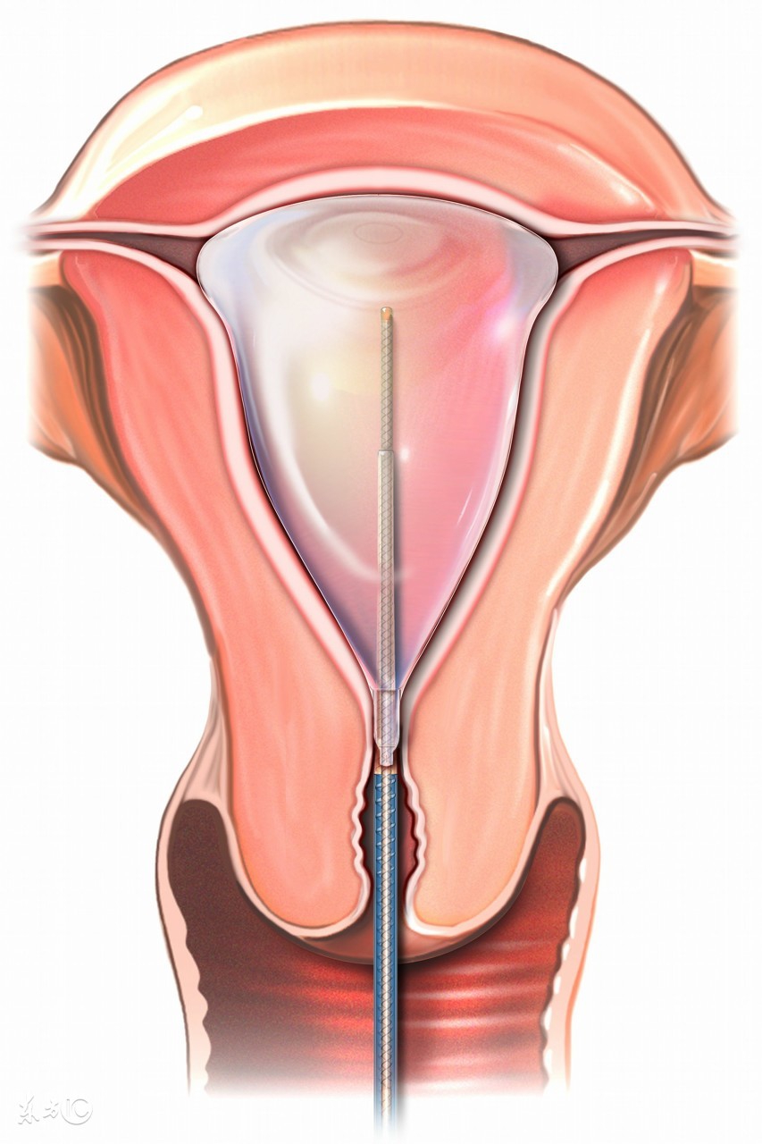 如何发现宫颈肥大,它的症状及病因又是什么