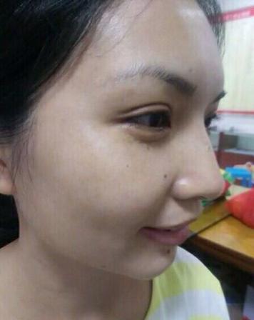 妈妈为女儿消脸上疤,妈妈为了孩子不容易