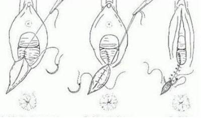 侧切后的疼痛期怎么熬过,侧切带来的后遗症