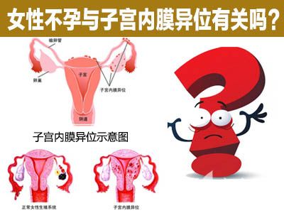 妇科炎症会引起子宫内膜异位症吗,妇科疑难杂症有哪些