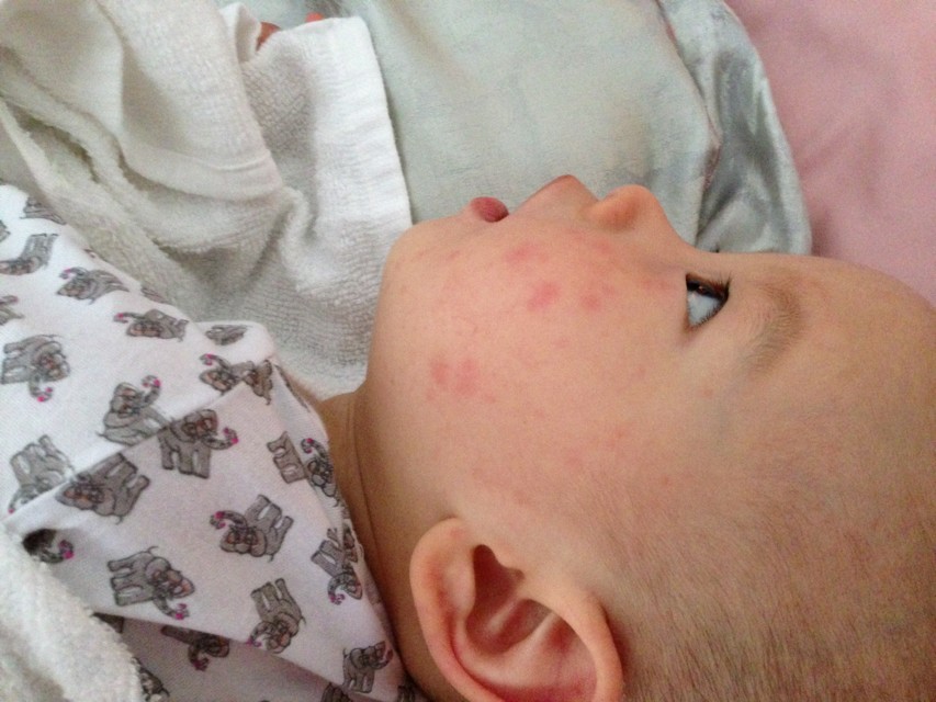 九个月宝宝出了一身疹子,9个月宝宝出些小红疹低烧