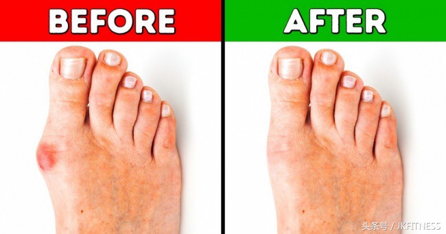 脚的拇指外翻老是磨成老茧怎么办,治疗脚大拇指外翻有什么好办法