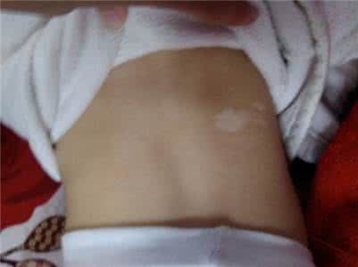 新生儿身上的白斑是怎么回事,新生儿有白斑是怎么回事