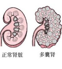 肾病复发几次就会肾衰竭与尿毒症,专治肾病的6大技巧