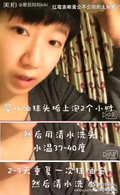 婴儿湿疹头垢洗了之后一直在出水,新生儿头垢和湿疹结痂的区别