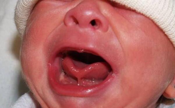 孩子的舌头是w型,宝宝的舌头是w型的应该挂什么科