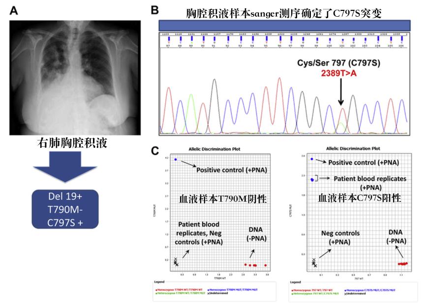 案例：奥希替尼（AZD9291）耐药后用回吉非替尼有效！