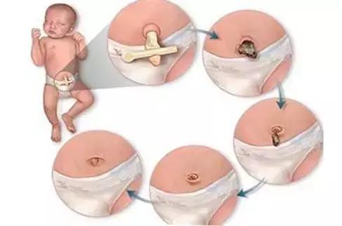 肚脐眼隐藏的秘密,肚脐眼的泥为什么不能抠