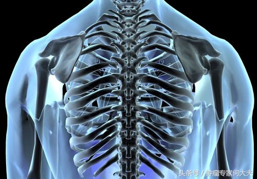 肺癌骨转移活了10年,肺癌脑转移骨转移活了10年