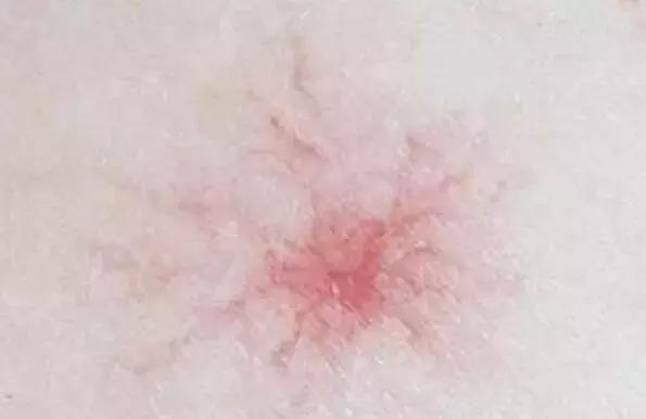 身上长了好多小红痣是怎么回事,出现小红痣不痛不痒