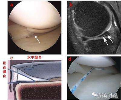 膝关节增生与滑膜炎的区别,关节炎滑膜炎骨质增生能治好吗